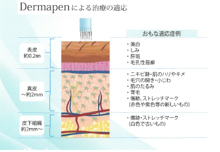 dermapen_img